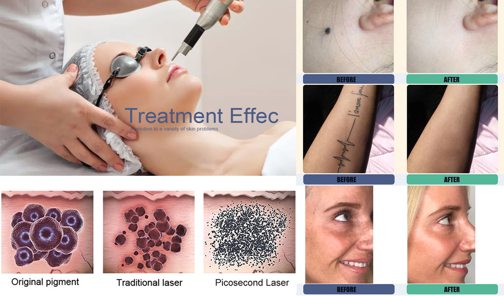 What can Pico laser be used to treat?